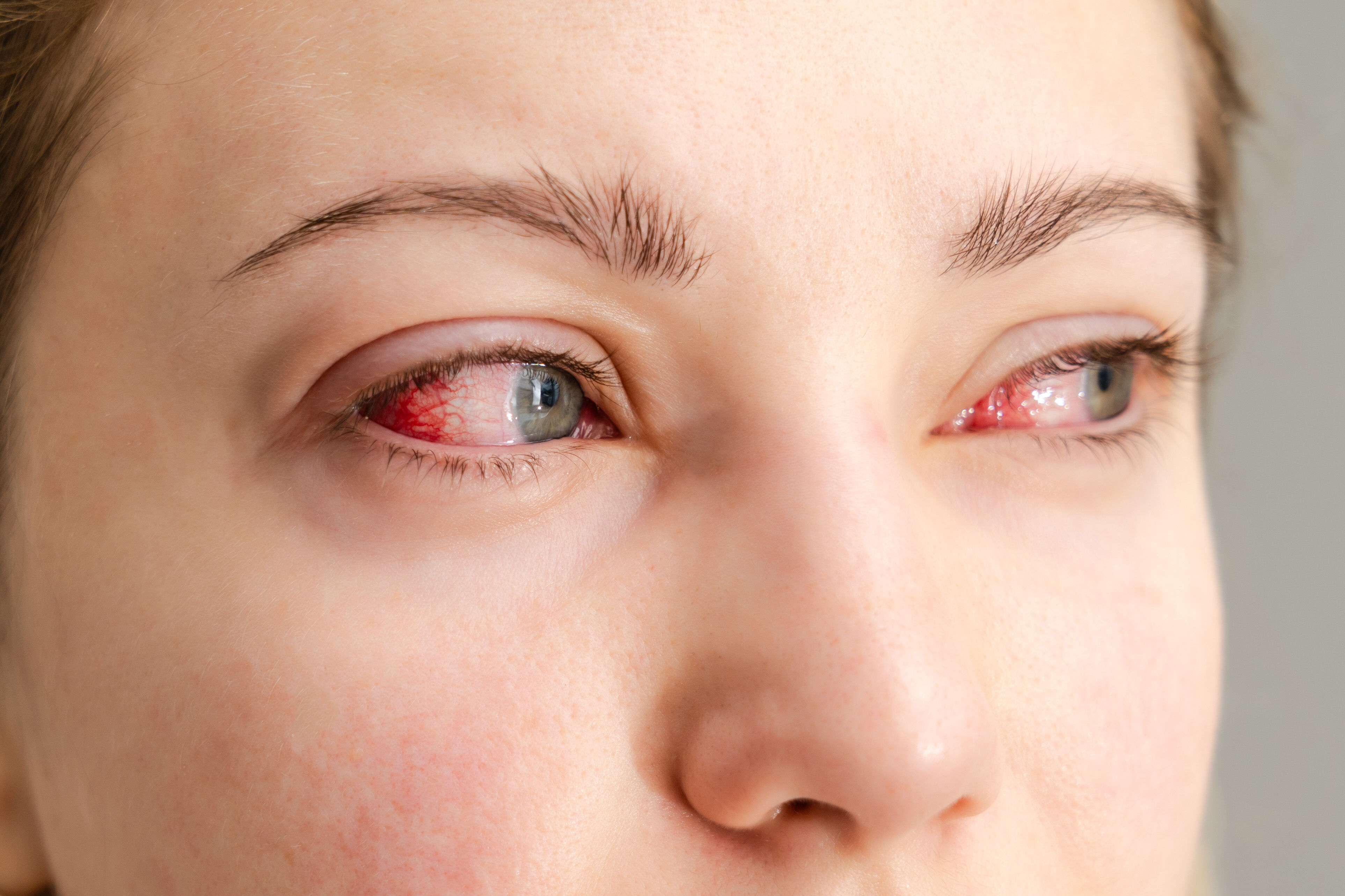 Yeux brûlés : causes, premiers secours