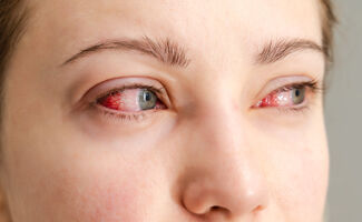 Yeux brûlés : causes, premiers secours