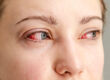 Yeux brûlés : causes, premiers secours