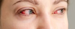 Yeux rouges